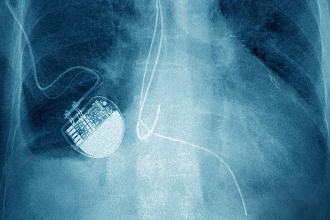 Pacemaker Death Proving the case for arson by evaluating pacemaker data – Critical Link